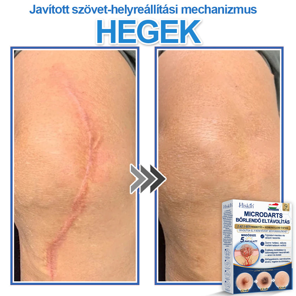 MĂĄr csak 7 csomag maradt! Szerezze meg a HISKINÂź tapaszt 80% kedvezmĂ©nnyel! BĂșcsĂșt mondhat a kellemetlen szemölcsöknek Ă©s bĆrkinövĂ©seknek 1â4 hĂ©t alatt. VillĂĄmakciĂł + 180 napos pĂ©nzvisszafizetĂ©si garancia. Siessen!