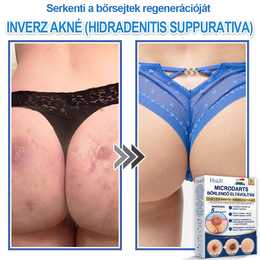 Már csak 7 csomag maradt! Szerezze meg a HISKIN® tapaszt 80% kedvezménnyel! Búcsút mondhat a kellemetlen szemölcsöknek és bőrkinövéseknek 1–4 hét alatt. Villámakció + 180 napos pénzvisszafizetési garancia. Siessen!