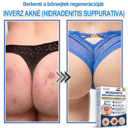 Már csak 7 csomag maradt! Szerezze meg a HISKIN® tapaszt 80% kedvezménnyel! Búcsút mondhat a kellemetlen szemölcsöknek és bőrkinövéseknek 1–4 hét alatt. Villámakció + 180 napos pénzvisszafizetési garancia. Siessen!