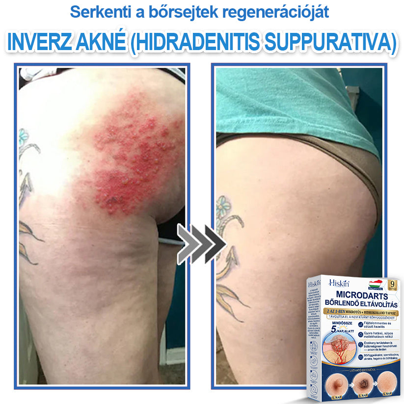 Már csak 7 csomag maradt! Szerezze meg a HISKIN® tapaszt 80% kedvezménnyel! Búcsút mondhat a kellemetlen szemölcsöknek és bőrkinövéseknek 1–4 hét alatt. Villámakció + 180 napos pénzvisszafizetési garancia. Siessen!