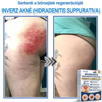 Már csak 7 csomag maradt! Szerezze meg a HISKIN® tapaszt 80% kedvezménnyel! Búcsút mondhat a kellemetlen szemölcsöknek és bőrkinövéseknek 1–4 hét alatt. Villámakció + 180 napos pénzvisszafizetési garancia. Siessen!