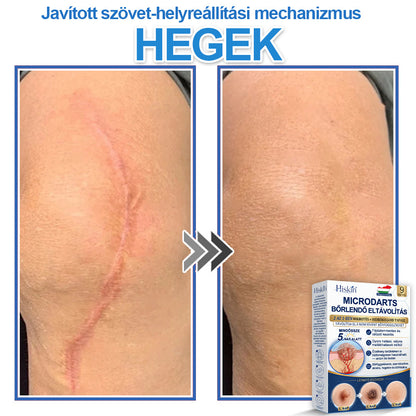 Már csak 7 csomag maradt! Szerezze meg a HISKIN® tapaszt 80% kedvezménnyel! Búcsút mondhat a kellemetlen szemölcsöknek és bőrkinövéseknek 1–4 hét alatt. Villámakció + 180 napos pénzvisszafizetési garancia. Siessen!