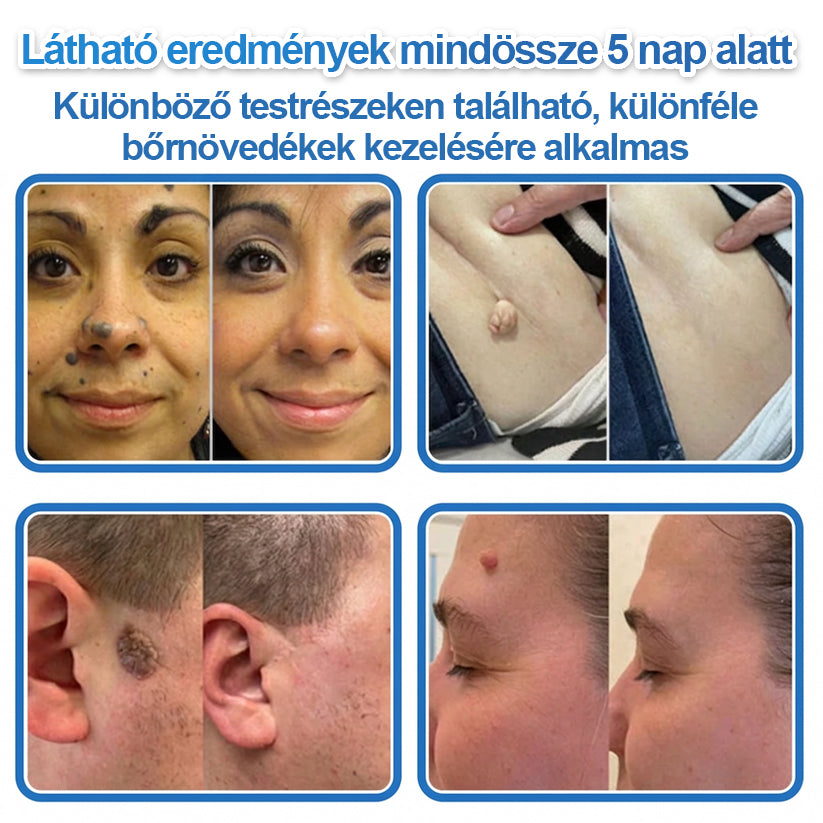 Már csak 7 csomag maradt! Szerezze meg a HISKIN® tapaszt 80% kedvezménnyel! Búcsút mondhat a kellemetlen szemölcsöknek és bőrkinövéseknek 1–4 hét alatt. Villámakció + 180 napos pénzvisszafizetési garancia. Siessen!
