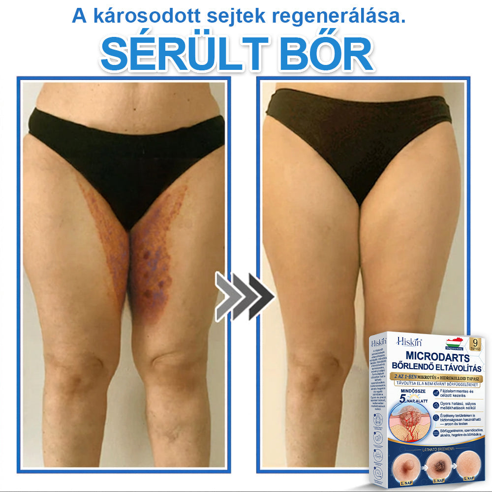 Már csak 7 csomag maradt! Szerezze meg a HISKIN® tapaszt 80% kedvezménnyel! Búcsút mondhat a kellemetlen szemölcsöknek és bőrkinövéseknek 1–4 hét alatt. Villámakció + 180 napos pénzvisszafizetési garancia. Siessen!