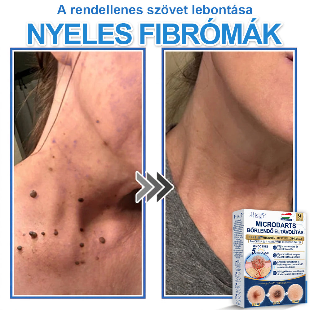 Már csak 7 csomag maradt! Szerezze meg a HISKIN® tapaszt 80% kedvezménnyel! Búcsút mondhat a kellemetlen szemölcsöknek és bőrkinövéseknek 1–4 hét alatt. Villámakció + 180 napos pénzvisszafizetési garancia. Siessen!
