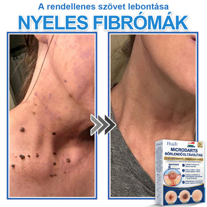 Már csak 7 csomag maradt! Szerezze meg a HISKIN® tapaszt 80% kedvezménnyel! Búcsút mondhat a kellemetlen szemölcsöknek és bőrkinövéseknek 1–4 hét alatt. Villámakció + 180 napos pénzvisszafizetési garancia. Siessen!