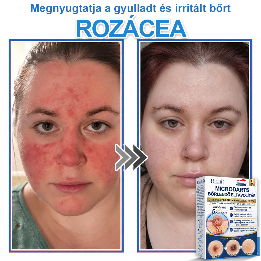 Már csak 7 csomag maradt! Szerezze meg a HISKIN® tapaszt 80% kedvezménnyel! Búcsút mondhat a kellemetlen szemölcsöknek és bőrkinövéseknek 1–4 hét alatt. Villámakció + 180 napos pénzvisszafizetési garancia. Siessen!