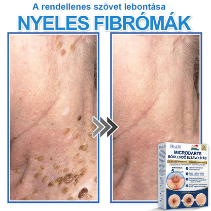 Már csak 7 csomag maradt! Szerezze meg a HISKIN® tapaszt 80% kedvezménnyel! Búcsút mondhat a kellemetlen szemölcsöknek és bőrkinövéseknek 1–4 hét alatt. Villámakció + 180 napos pénzvisszafizetési garancia. Siessen!